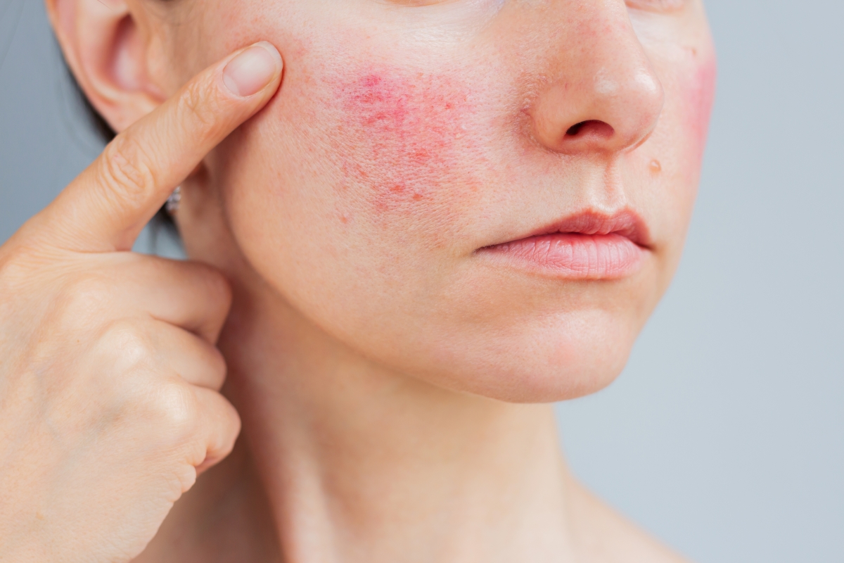Kvinde, der peger på rosacea-udbrud på sin kind